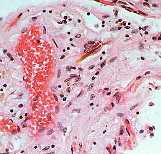 Asbestos Fibers Embedded in a Lung